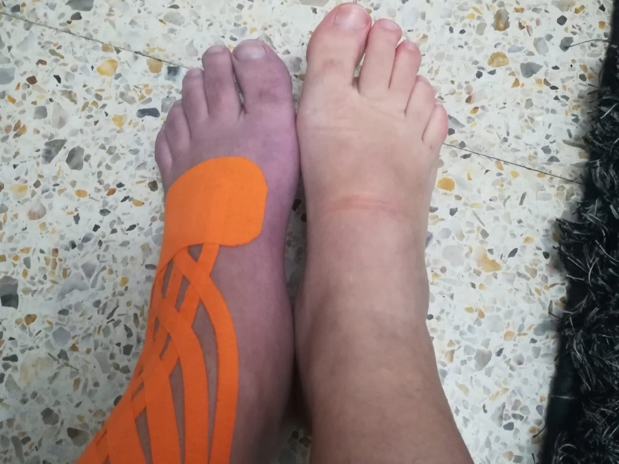 Pé de ana belén, sudeck